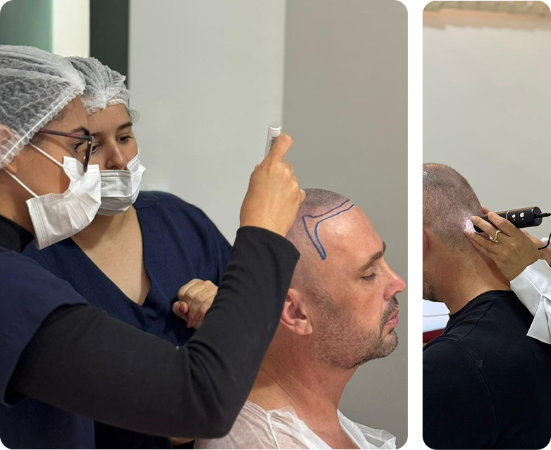 Transplante Capilar em Paulínia e Campinas
